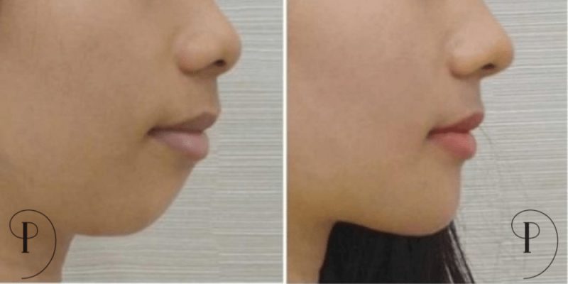 affordable cosmetic surgery