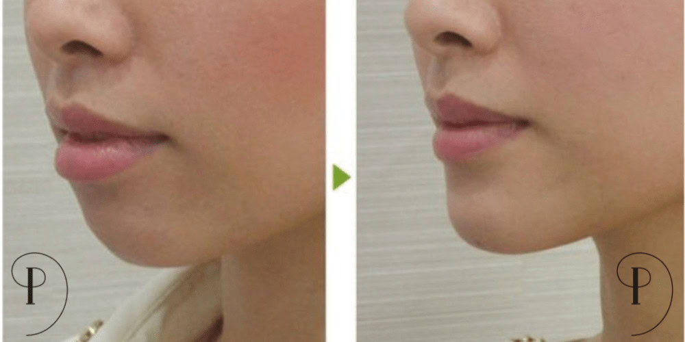 Chin Augmentation