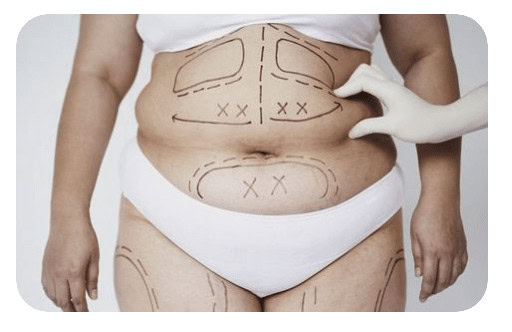 Liposuction with Dr.Phuc Dinh