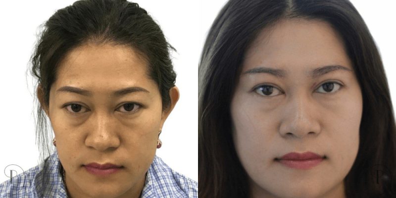 affordable cosmetic surgery