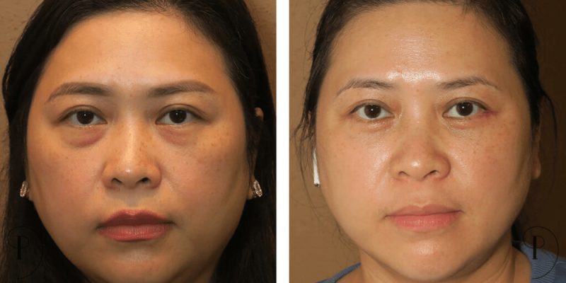 affordable cosmetic surgery
