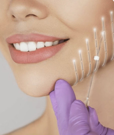 thread lift with Dr.Phuc Dinh