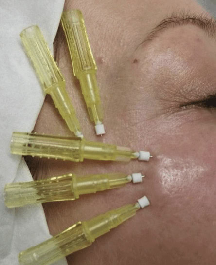 thread lift with Dr.Phuc Dinh