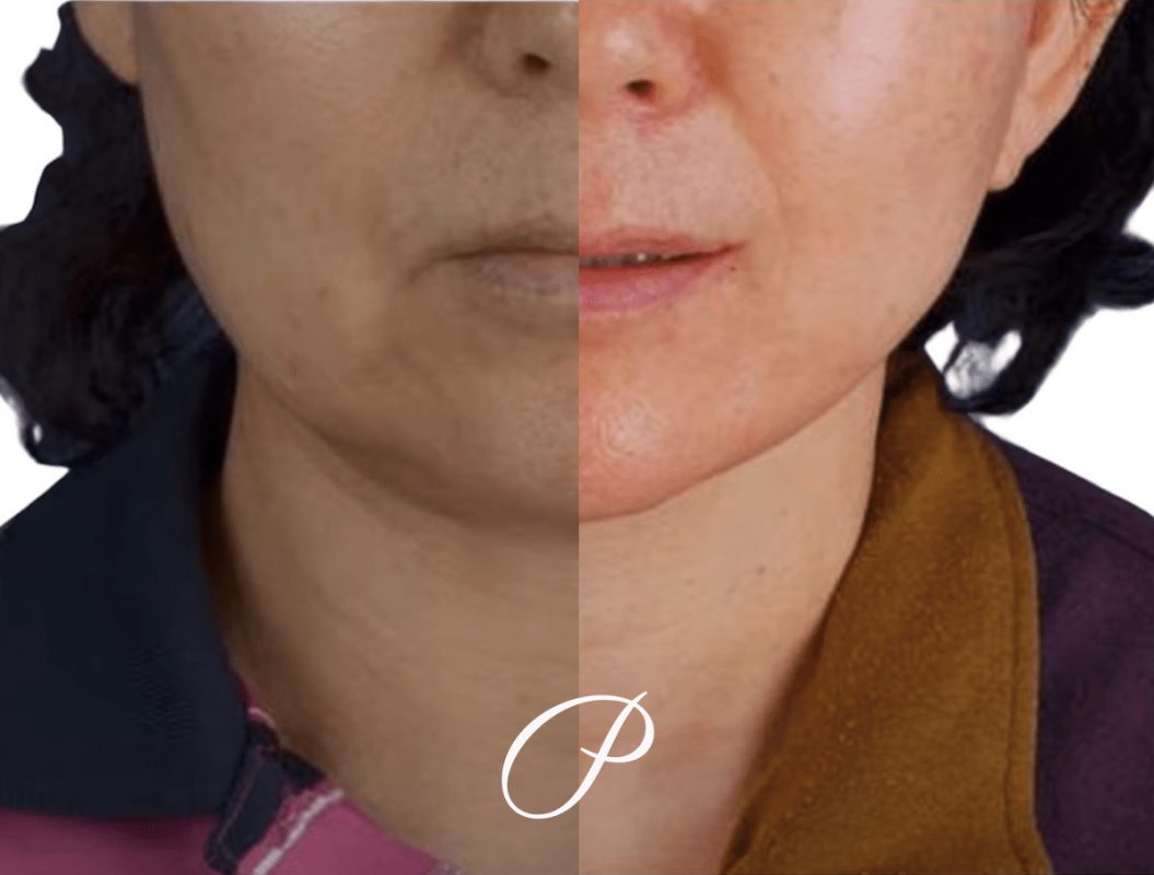 Facelift with Dr.Phuc Dinh