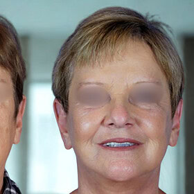 cheek augmentation, cheek implant