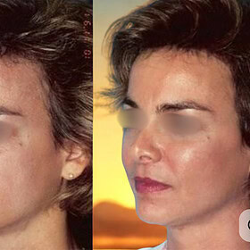 cheek implant, cheek augmentation