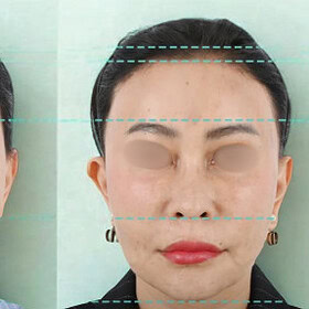 hairline lowering - patient 1