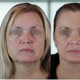cheek augmentation, cheek implants