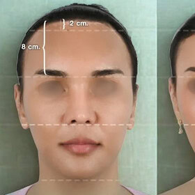 hairline lowering - patient 2