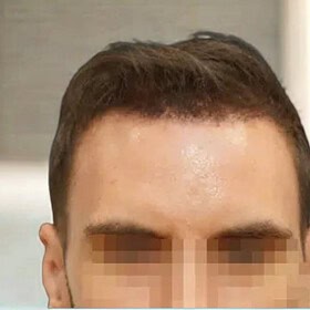 hairline lowering - patient 3